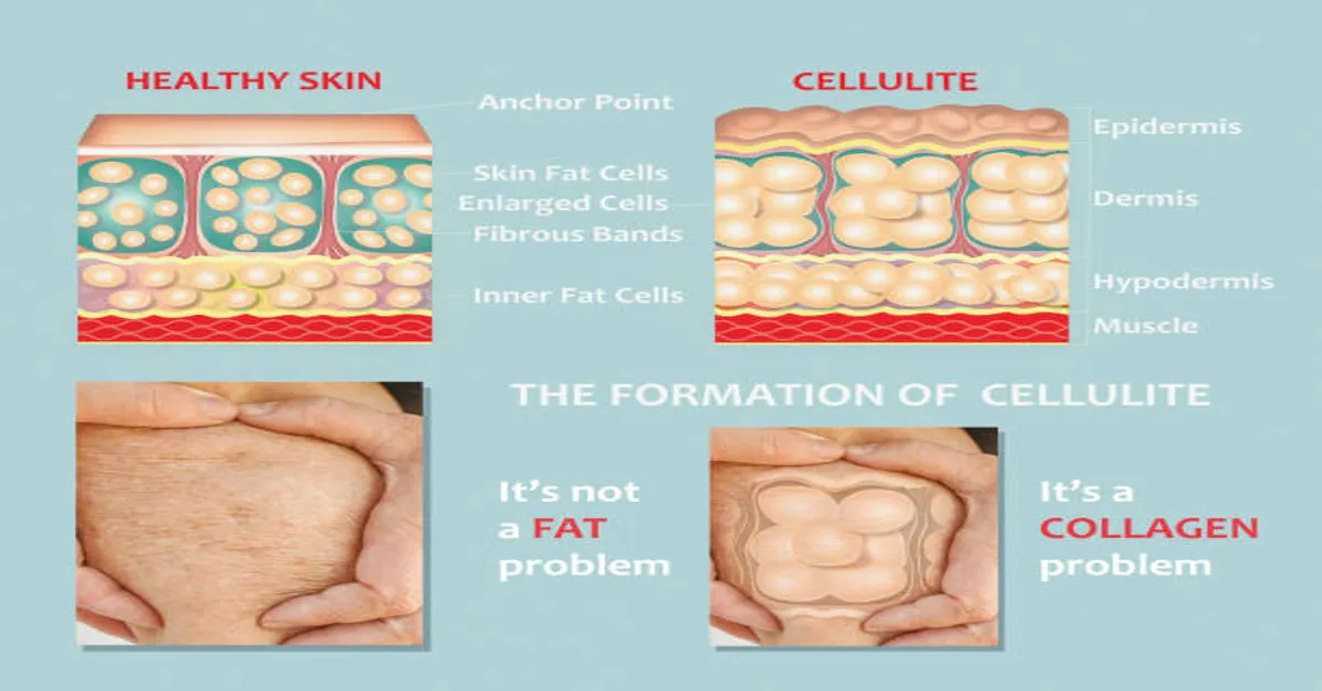 Cellulysis